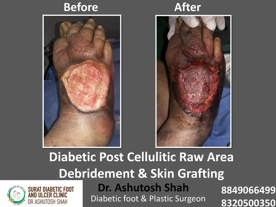 Diabetic Cellulitis and Coverage.pptx-21.webp